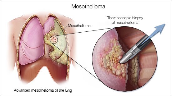 aggressive cancer, Mesothelioma cancer